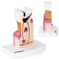 shumee Anatomski model obolelega človeškega zoba v merilu 6:1