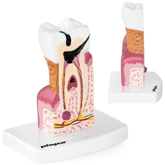 shumee Anatomski model obolelega človeškega zoba v merilu 6:1