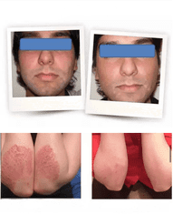 Svetilka za fototerapijo z UVB 311 nm, Psoriaza, vitiligo, ekcem - komplet z glavnikom