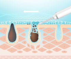 shumee Brezžična naprava za kavitacijski piling, komplet za čiščenje s trdnimi sestavinami