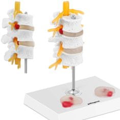 shumee 3D anatomski model ledvene hrbtenice s hernijo vretenc 3-5